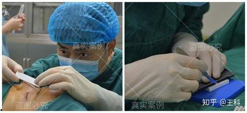 垫假体视频,术前术后护理与恢复指南